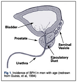 Prostate Benign Prostatic Hypertrophy